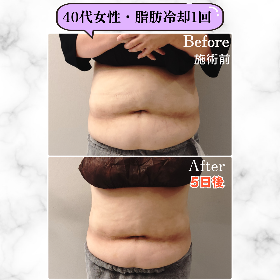 2023年最新　脂肪冷却新品 脂肪冷却